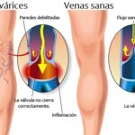 Conferencia Gratuita Sobre Circulación Y Varices